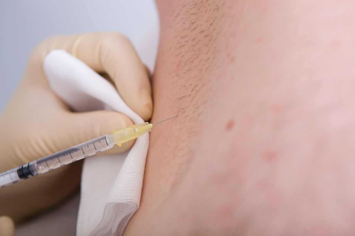 Injektionsnadel für die Behandlung gegen Schwitzen mit Botox im Fall einer Achsel